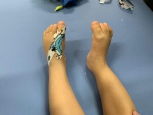 PEZINHO HALUX EM GARRA 03